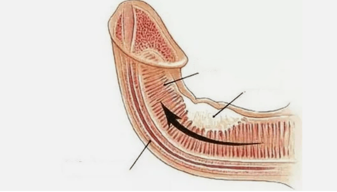 Elimination of the venous outflow